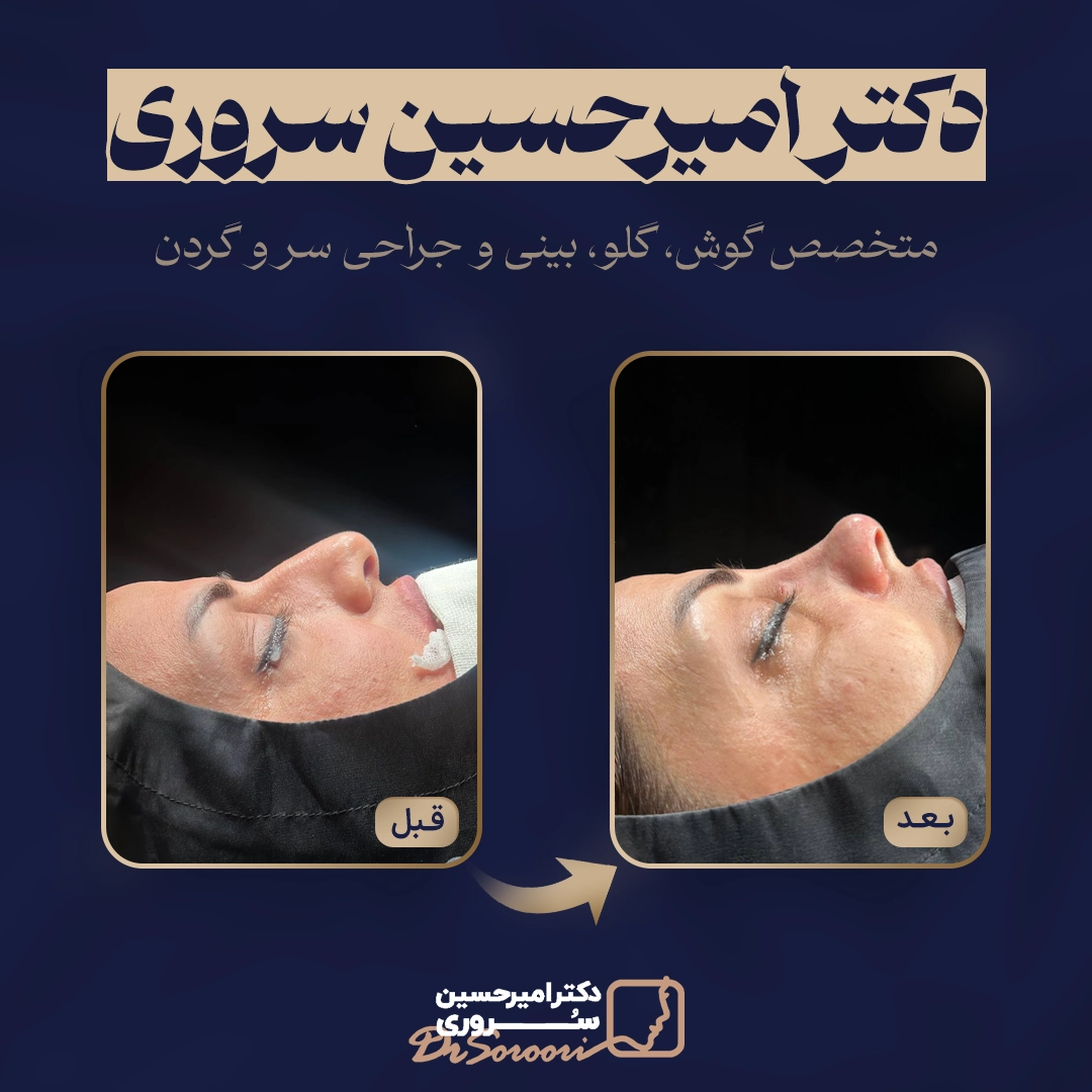 نمونه‌کار عمل بینی استخوانی دکتر سروری