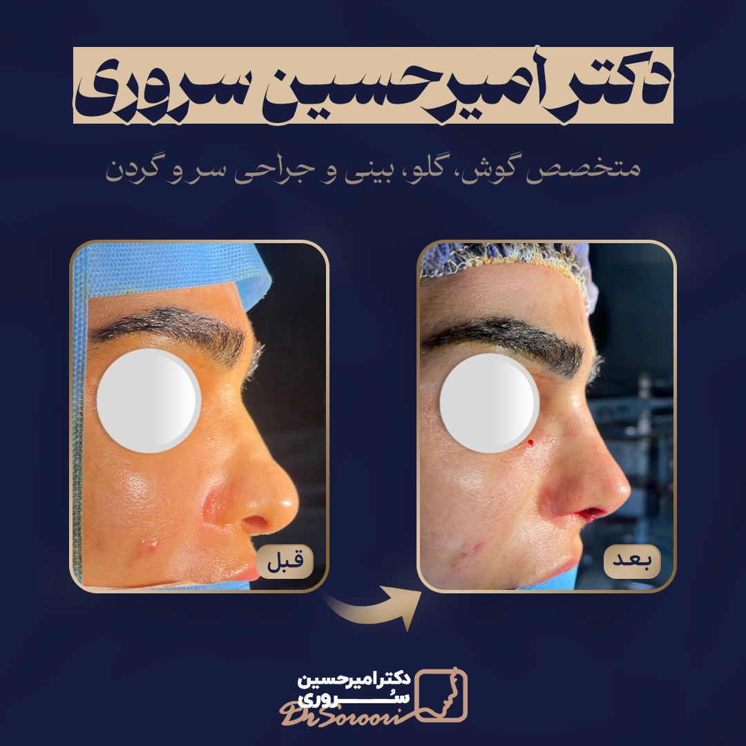 نمونه کار جراحی بینی ترمیمی دکتر سروری