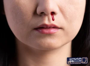 خونریزی بعد از عمل بینی - دکتر سروری