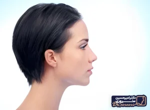 یک ماه بعد از عمل بینی - دکتر امیرحسین سروری جراح بینی مشهد