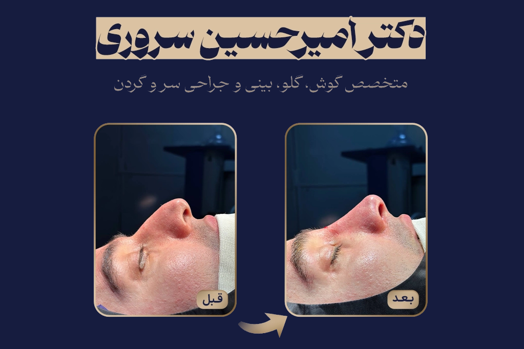 نمونه عمل جراحی بینی استخوانی در مشهد دکتر سروری
