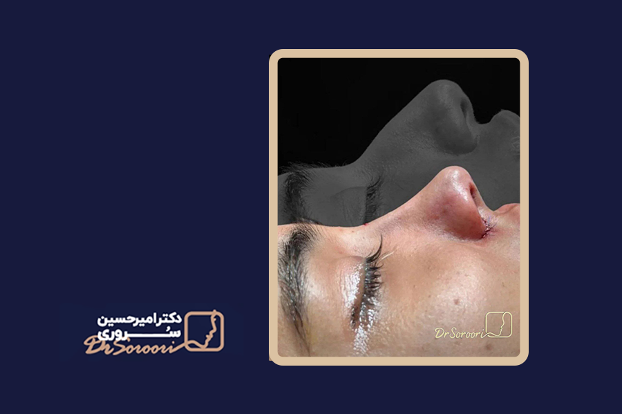 نمونه جراحی بینی طبیعی زنانه