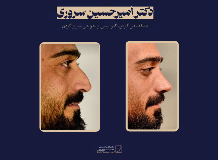 نمونه جراحی طبییعی بینی مردانه