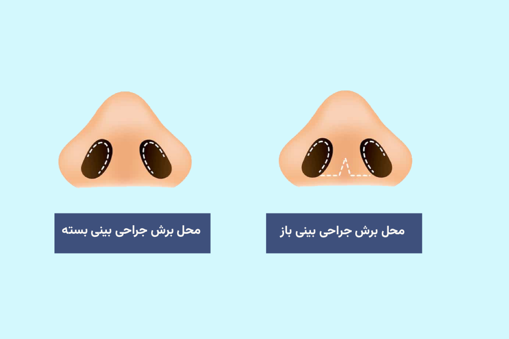 محل برش جراحی بینی باز و بسته