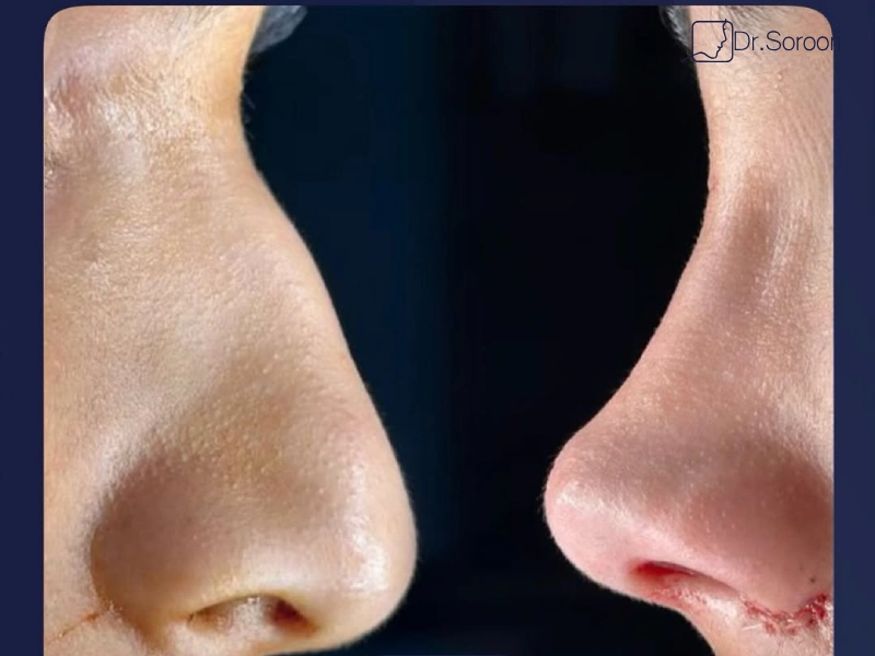 فواید ماساژ بینی بعد از عمل